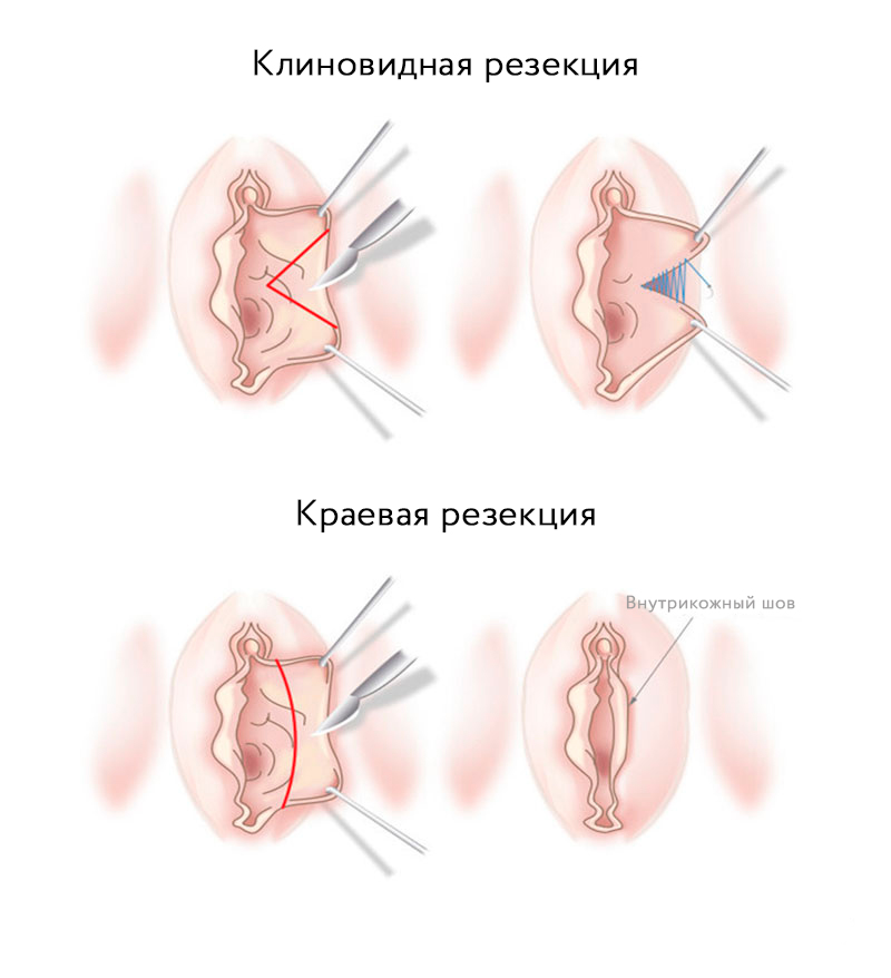 способы уменьшения половых губ