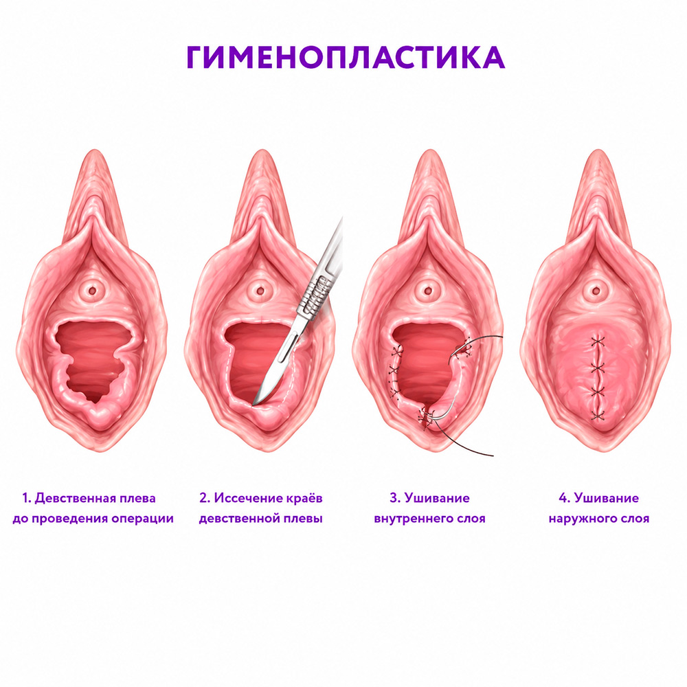 гименопластика-процесс.jpg