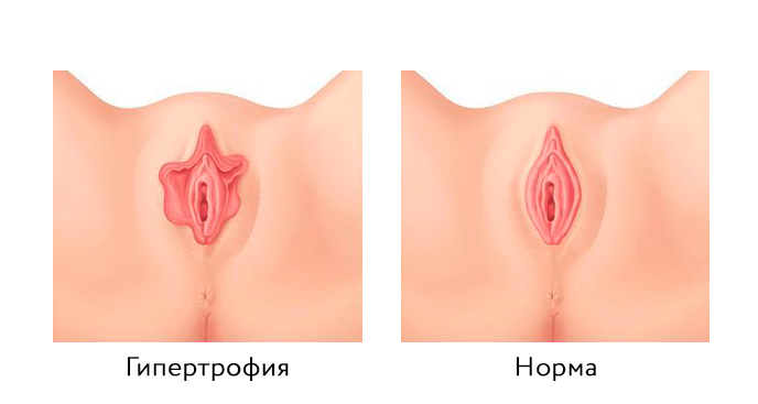 гипертрофия малых половых губ