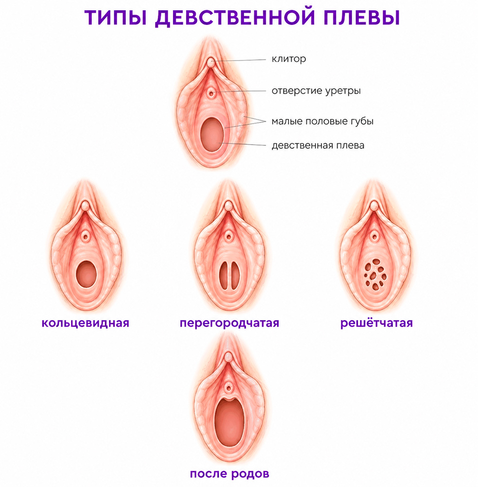 типы девственной плевы.jpg