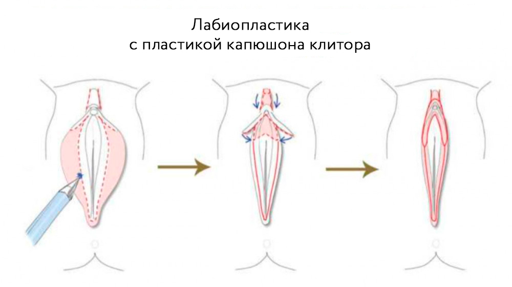 Типы-резекции-мпг.jpg